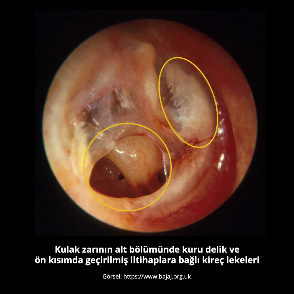 Delik Kulak Zarı - Prof. Dr. Çetin Vural
