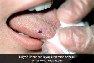 Dil biyopsi - Prof. Dr. Çetin Vural