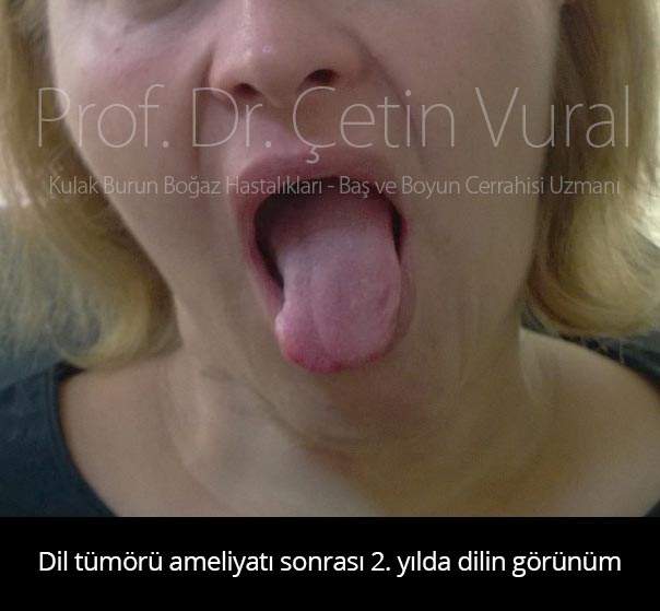 Dil Kanseri Ameliyatı Sonrası - Prof. Dr. Çetin Vural