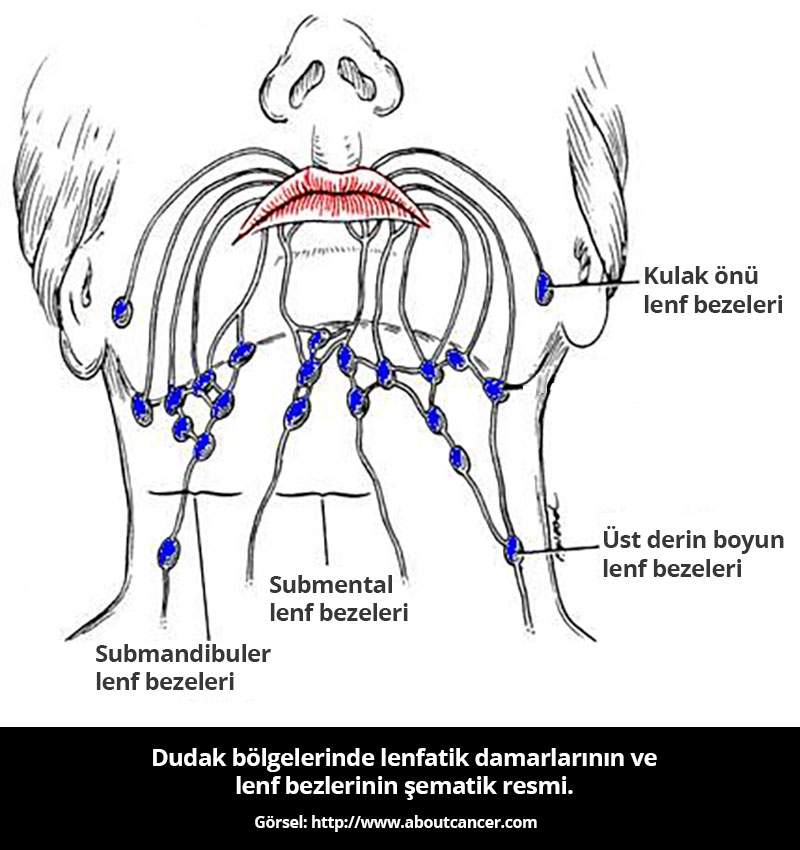 Dudak kanserlerinin cerrahi tedavisinde boyun diseksiyonu 