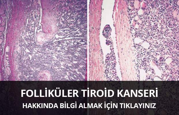 Folliküler Tiroid Kanseri - Prof. Dr. Çetin Vural