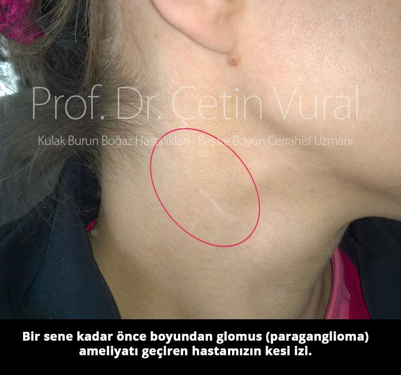 Glomus Ameliyatı Kesi İzi - Prof. Dr. Çetin Vural