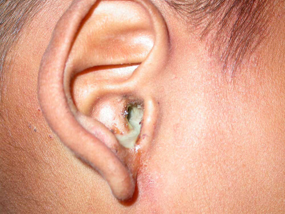 Kulak Akıntısı - Prof. Dr. Çetin Vural
