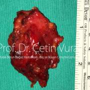 Low Grade Mukoepidermoid Karsinom