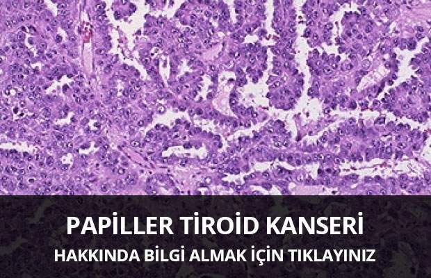 Papiller Tiroid Kanseri - Prof. Dr. Çetin Vural