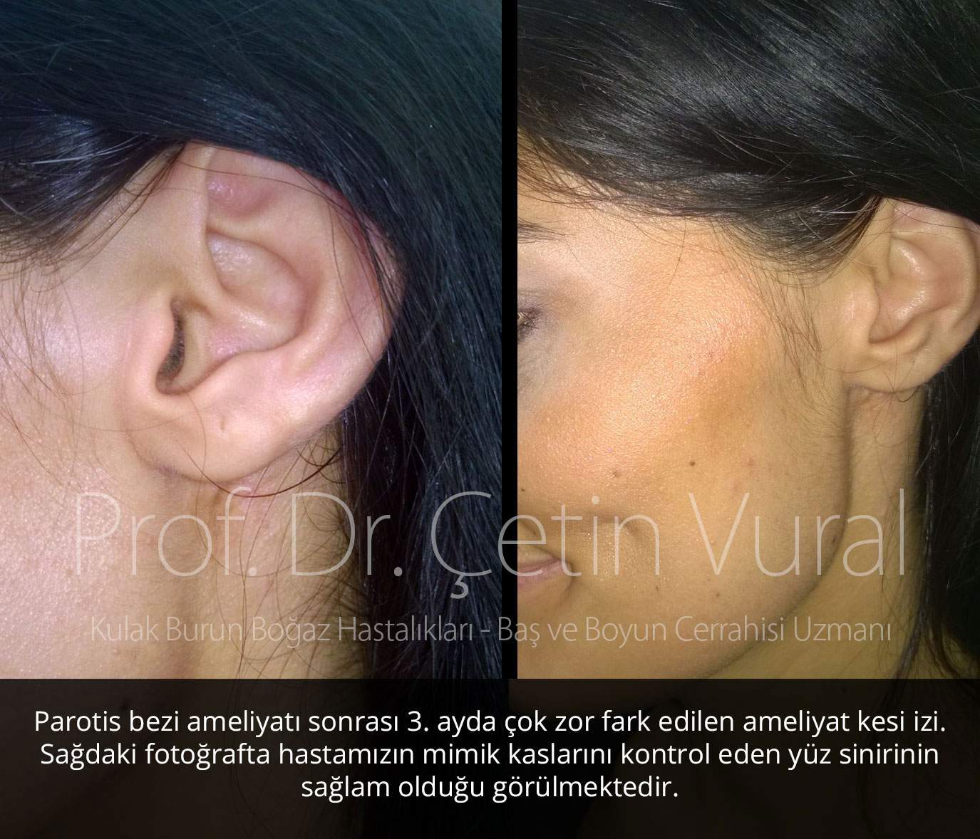 Parotis Ameliyatı sonrası İz 02 - Prof. Dr. Çetin Vural