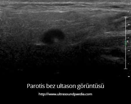 Parotis Bez - Ultrason