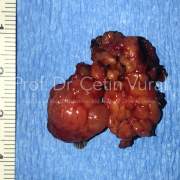Pleomorfik Adenoma