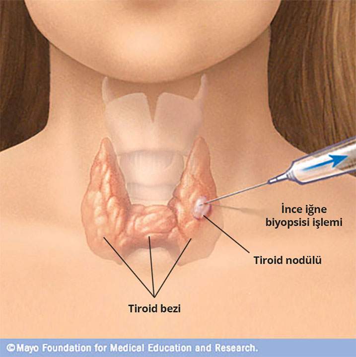 Tiroid nodülüne ince iğne aspirasyon biyopsisi  - Prof. Dr. Çetin Vural