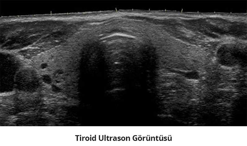 Tiroid Ultrason Görüntüsü - Prof. Dr. Çetin Vural