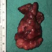 Sol Submandibular Bezde Pleomorfik Adenom