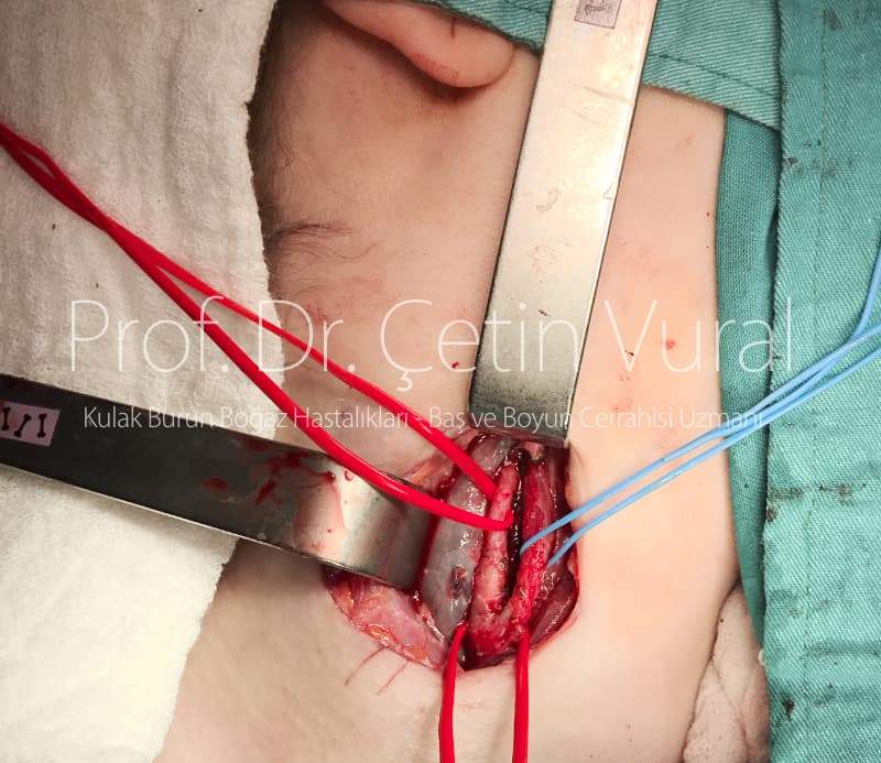 Sağ Paragangliom (Karotid Cisim Tümörü, Glomus Karotikum) Ameliyatı