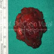 Sol Parotis Tükürük Bezinde Düşük Dereceli Mukoepidermoid Karsinoma - Prof. Dr. Çetin Vural