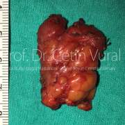 Sol Submandibular (Çenealtı) Tükürük Bezinde Taş - Prof. Dr. Çetin Vural