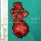 Sağ Submandibular (çene altı) Tükürük Bezinde Pleomorfik Adenom - Prof. Dr. Çetin Vural
