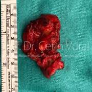 Sağ Parotid Bezde Brankial Yarık Kisti - Prof. Dr. Çetin Vural