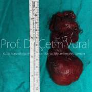 Tiroit Bezinde İri Nodüller - Prof. Dr. Çetin Vural