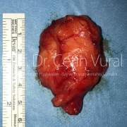 Sol Parotis Tükürük Bezinde Lipoma - Prof. Dr. Çetin Vural