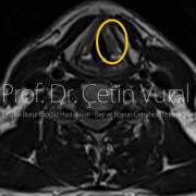 Sol Vokal Kord (Ses Teli) Skuamoz Hücreli Kanserinin Laser Cerrahisi ile Tedavisi - Prof. Dr. Çetin Vural