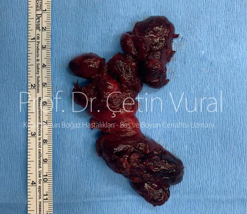 Tiroit Bezinde Multifokal Papiller Karsinom - Prof. Dr. Çetin Vural