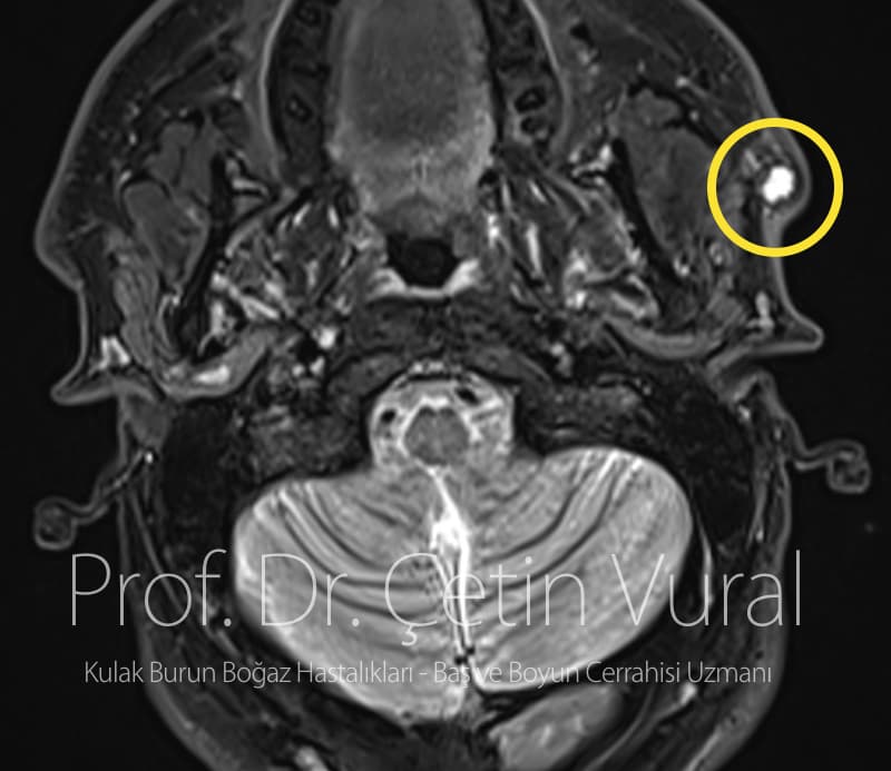 Parotis Tükürük Bezi Yüzeyinde İnfundibuler Kist - Prof. Dr. Çetin Vural