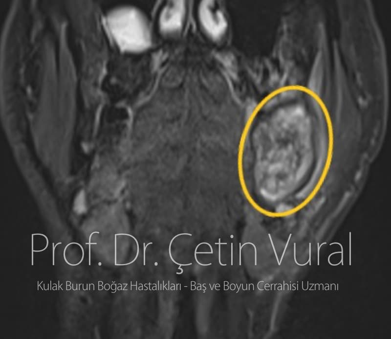 Mandibulada (Alt Çene Kemiği) Osteokondromiksom - Prof. Dr. Çetin Vural