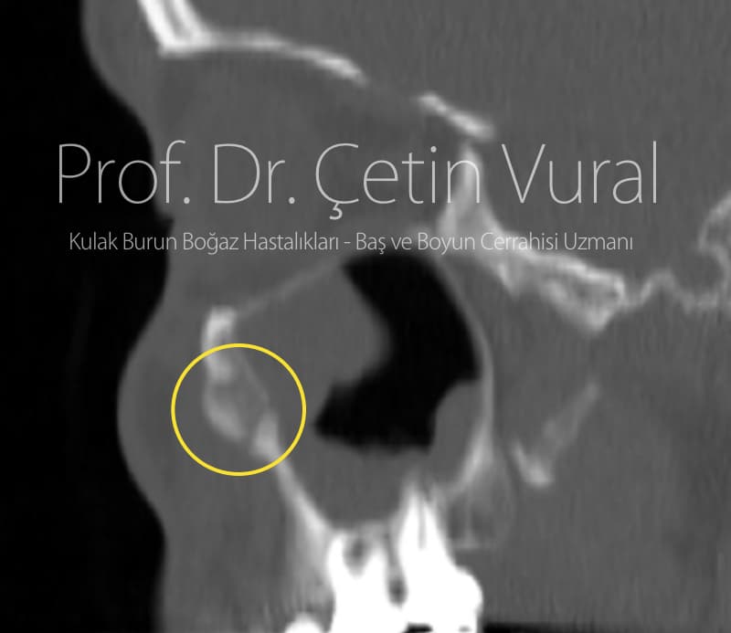 Sağ Maksiller Kemik Ön Duvarında Osteoblastom - Prof. Dr. Çetin Vural