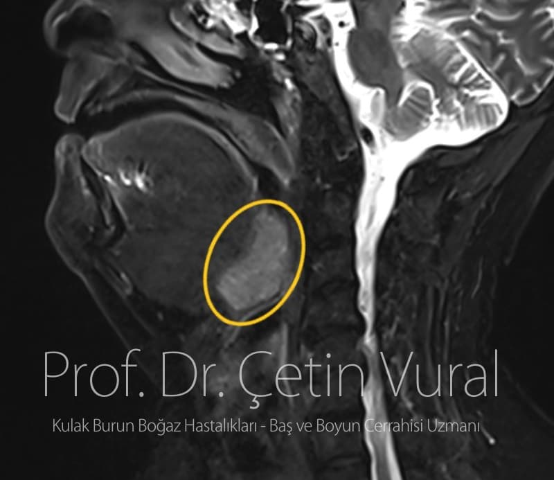 Boyunda İri Lenf Nodları ve Çok İri Lingual Tonsiller (Dil Kökü Bademciği)