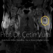Sol Parotis Bez Derin Lobda Yüksek Derece Mukoepidermoid Karsinoma - Prof. Dr. Çetin Vural