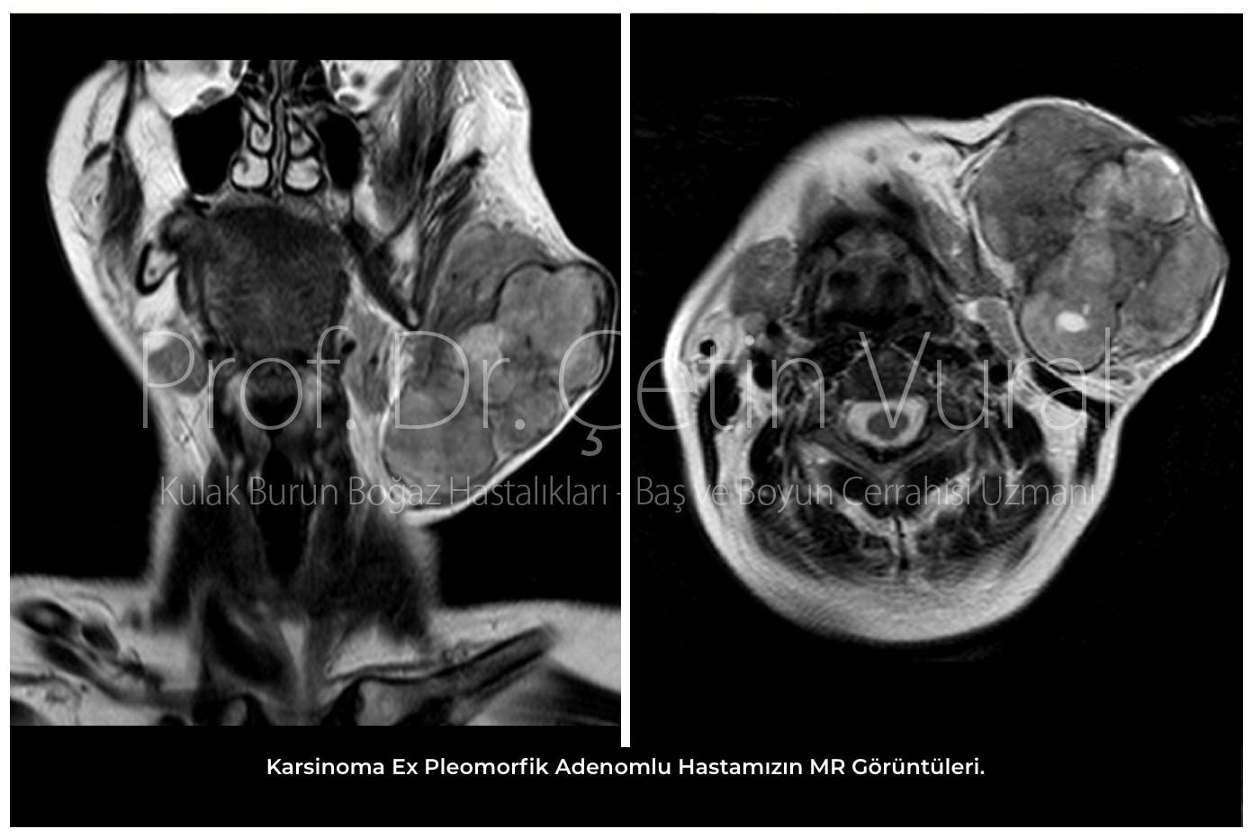 Karsinoma Ex Pleomorfik Adenomlu Hastamızın MR Görüntüleri - Prof. Dr. Çetin Vural