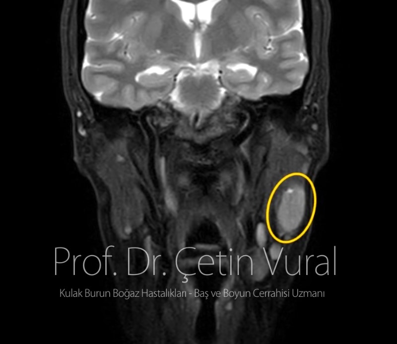 Sol Parotis Tükürük Bezinde Lenfoepitelyal Karsinom - Prof. Dr. Çetin Vural