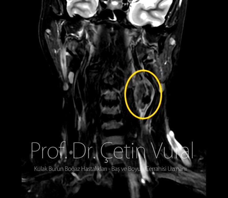 Boyun Sol Tarafta Karotid Cisim Tümörü - Prof. Dr. Çetin Vural