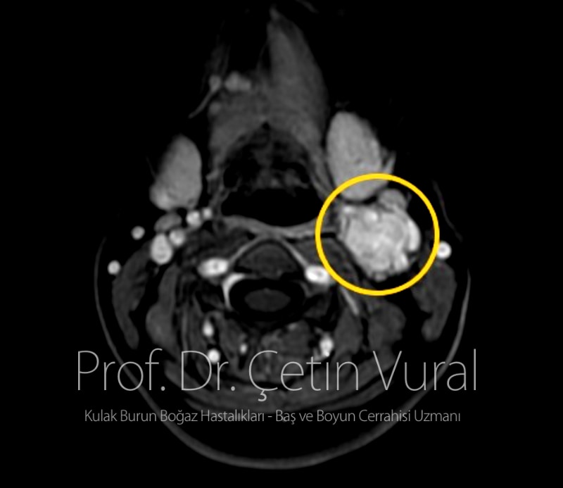 Boyun Sol Tarafta Karotid Cisim Tümörü - Prof. Dr. Çetin Vural