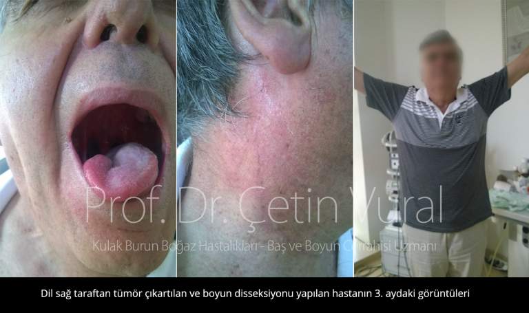 Dil, Ağız Boşluğu ve Yutak Kanseri Tedavisi Sonrası Süreç Prof. Dr