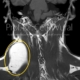 Boyun Arka Üçgenine Yerleşmiş Lipom - Prof. Dr. Çetin Vural